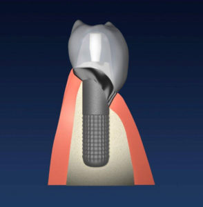 Indi Implantat mit Krone